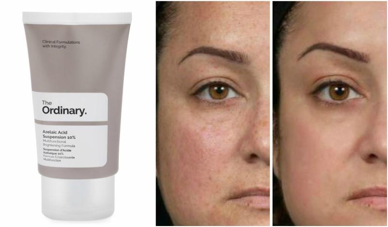 OD - Azelaic Acid Suspension 10% - 30ml